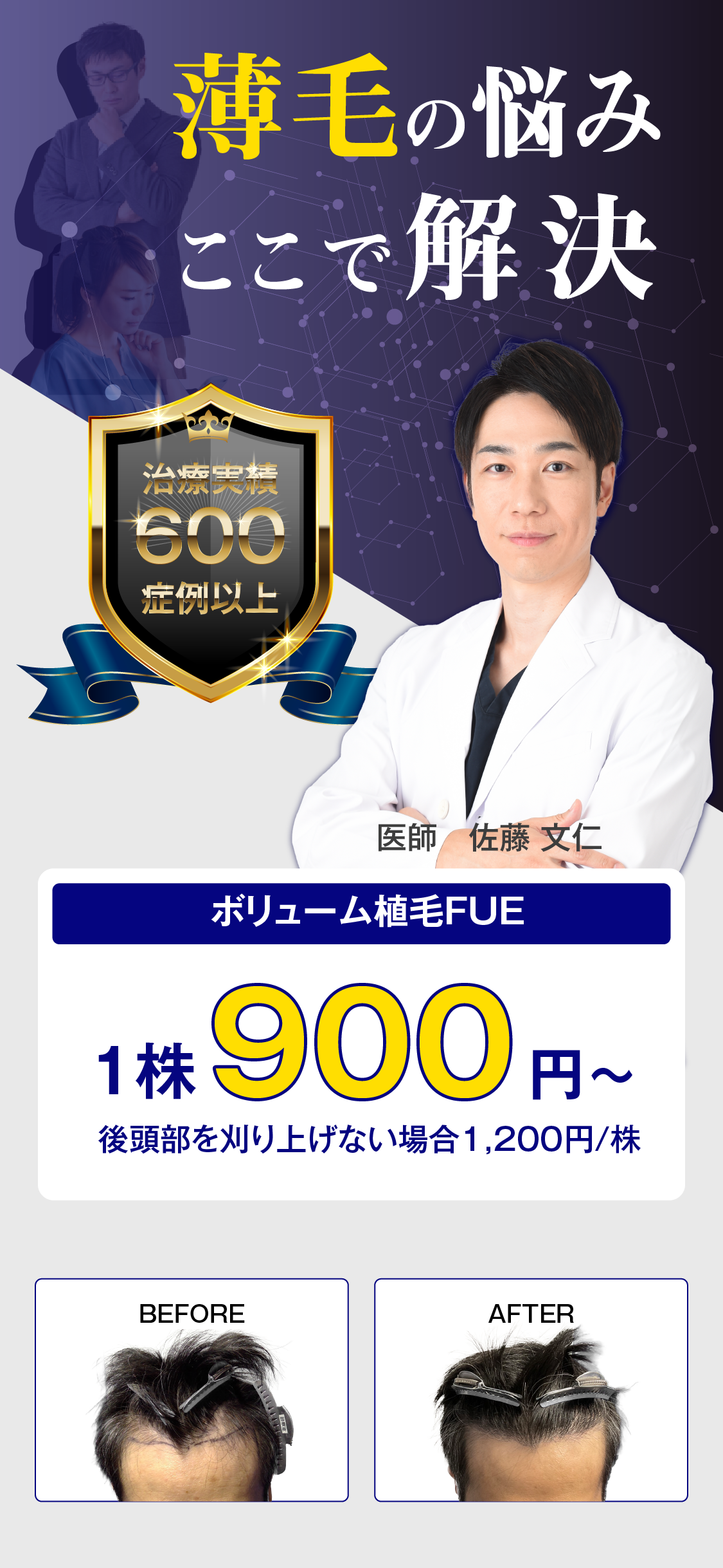 治療実績600症例以上 薄毛のお悩みここで解決 飲み薬や付け薬で効果がなかった方 当院の先進的な植毛手術で解決しましょう。ボリューム植毛FUE 1株900円〜 後頭部を刈り上げない場合 1,200円/株