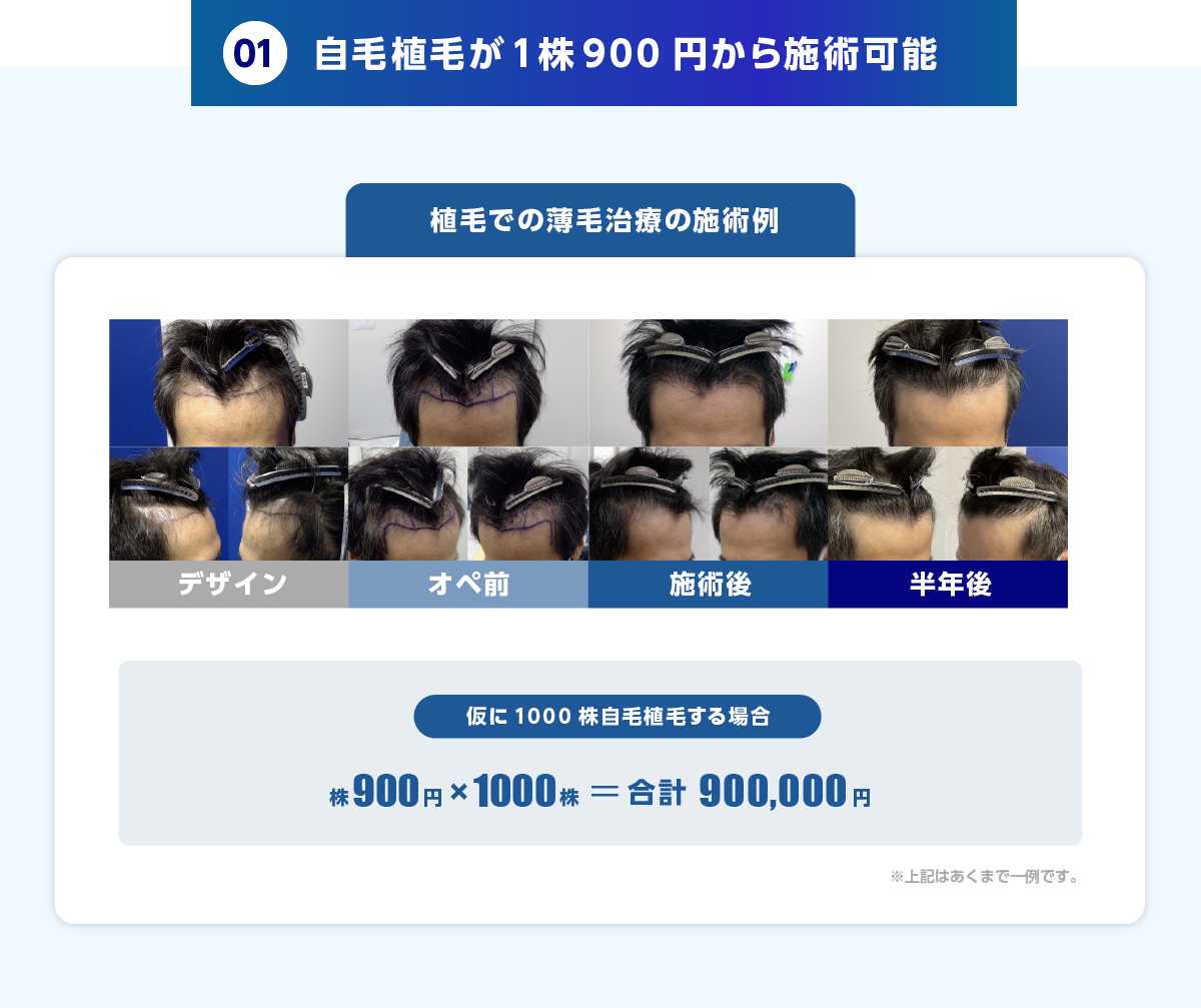 01.自毛植毛が1株900円から施術可能 業界では自毛植毛の場合、 1株あたり平均1,000円ほどの費用がかかります。
しかし、東京植毛美容外科では、薄毛対策の中でも確実性が高い植毛を、より多くの方に植毛を体験していただき、身近に感じてほしいという思いから、破格の値段で提供しています。 植毛での薄毛治療の施術例 デザイン オペ前 施術後 半年後 薬の服用を20年継続する場合 株900円 × 1000株＝合計900,000円 ※上記はあくまで一例です。 施術の時間としては日帰りでの施術が可能なので最短1日で終了します。金額に関しても希望の株数によって金額は変わりますが100万円以下での施術が可能になります。ご自身の毛根を移し替えるので、薬での治療に比べて薄毛改善の確率がほぼ100%に近くものになり、結果的に薬の服用に比べ安く、確実性の高い施術を受けることができます。
薬での薄毛治療の施術例 薬の服用を20年継続する場合 月額6,000円 × 12ヶ月 × 20年 ＝ 合計1,440,000円 ※上記はあくまで一例です。 薄毛の進行を止めて発毛を実感したい場合は飲み続けなければならないため、 月々は安く感じても結果的に100万円以上の費用が掛かってしまいます。薬でのメリットは手軽に発毛を目指せることですが、デメリットととしては、確実性が下がるのと、これからの人生継続して服用できる自信のない方はオススメできません。