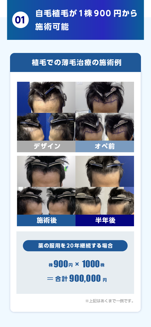 01.自毛植毛が1株900円から施術可能 業界では自毛植毛の場合、 1株あたり平均1,000円ほどの費用がかかります。
しかし、東京植毛美容外科では、薄毛対策の中でも確実性が高い植毛を、より多くの方に植毛を体験していただき、身近に感じてほしいという思いから、破格の値段で提供しています。 植毛での薄毛治療の施術例 デザイン オペ前 施術後 半年後 薬の服用を20年継続する場合 株900円 × 1000株＝合計900,000円 ※上記はあくまで一例です。 施術の時間としては日帰りでの施術が可能なので最短1日で終了します。金額に関しても希望の株数によって金額は変わりますが100万円以下での施術が可能になります。ご自身の毛根を移し替えるので、薬での治療に比べて薄毛改善の確率がほぼ100%に近くものになり、結果的に薬の服用に比べ安く、確実性の高い施術を受けることができます。
薬での薄毛治療の施術例 薬の服用を20年継続する場合 月額6,000円 × 12ヶ月 × 20年 ＝ 合計1,440,000円 ※上記はあくまで一例です。 薄毛の進行を止めて発毛を実感したい場合は飲み続けなければならないため、 月々は安く感じても結果的に100万円以上の費用が掛かってしまいます。薬でのメリットは手軽に発毛を目指せることですが、デメリットととしては、確実性が下がるのと、これからの人生継続して服用できる自信のない方はオススメできません。