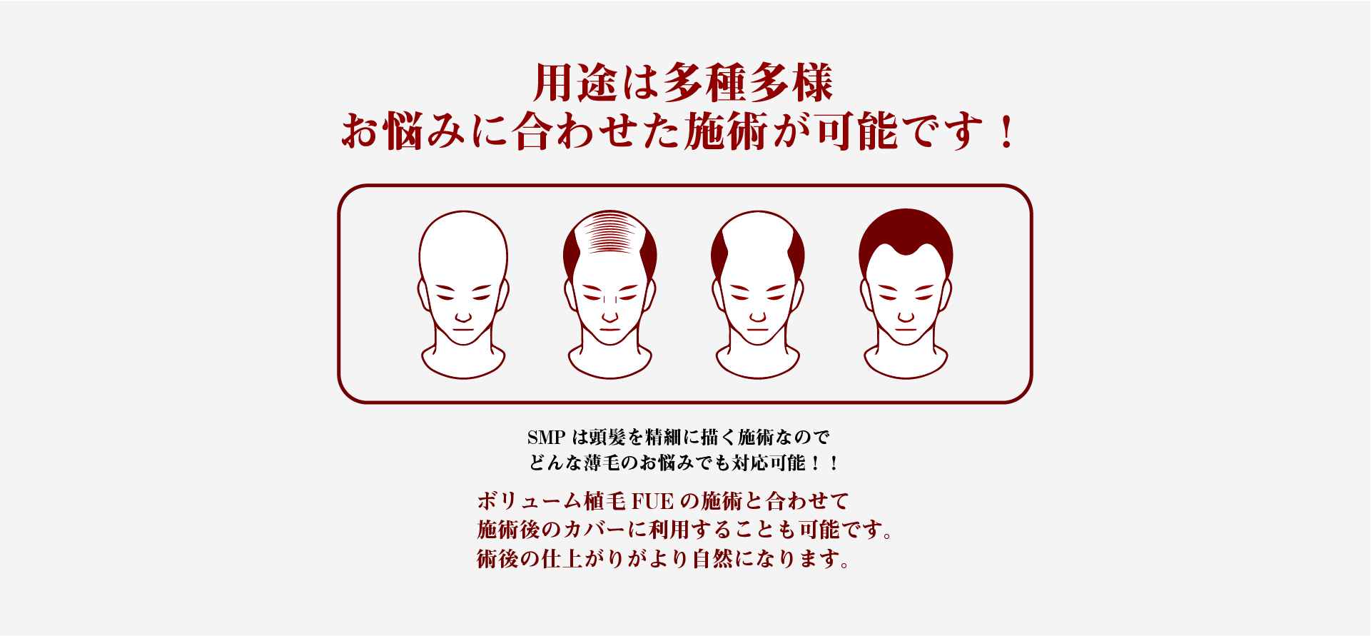 用途は多種多様、お悩みに合わせた施術が可能です！！ボリューム植毛FUE施術と合わせて施術後のカバーに利用することも可能です。